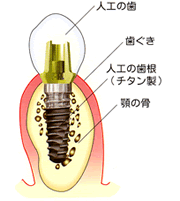 インプラント図