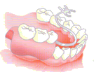 従来の治療法（部分入れ歯）
