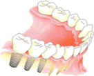 インプラント治療（奥歯）