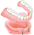 インプラント治療（総入れ歯）