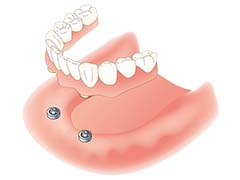 インプラント治療（総入れ歯）